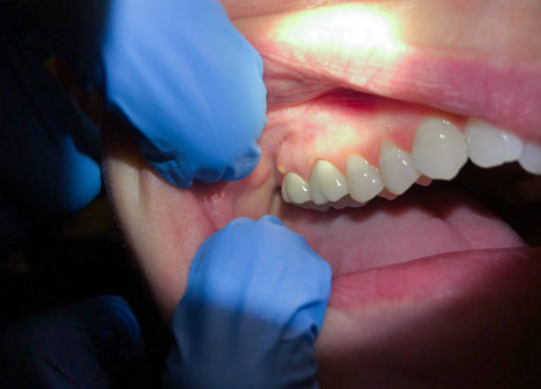 Best Emergency Dental Care for Broken or Chipped Teeth in Stagecoach, NV